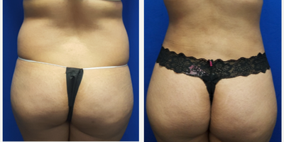 25-34 year old woman treated with Liposculpture - 26 year old female who had liposuction of her lower back and waist as part of her mommy makeover. She also had a tummy tuck at the same time. She had liposuction with Vaser and Power Assisted Technology. 1850cc's was removed from her lower back and waist. Her preop height was 5 feet and weight was 142 lbs. She has three children.