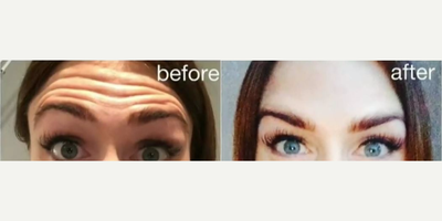 25-34 year old woman treated with Botox - Patient was treated with Botox on the forehead.