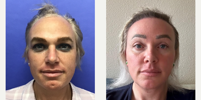 Patient treated with Facial Feminization Surgery, Transgender Facial Feminization Surgery, Facelift, Rhinoplasty, Septoplasty, C - 35 to 44 year-old female patient is 2 years and 3 months post-op from Facial Feminization surgery. Her procedures included: Placement of Tissue Expander for Mayer Flap, Forehead Lift and Orbital Bony Contouring, Septorhinoplasty (closed) with Cartilage Grafts and Weirs, Cheek Implants (small), Chin Reduction and Contour, Subnasal Lip Lift with Fat Augmentation to Lips, Medium Facelift, Voluma 1cc to Nasolabial Depressions and Medial Cheeks, Juvederm 1cc to Facial Rhytids and Chin Dimple, Periorbital TCA, and Removal of two moles on face. Patient is 1 year 11 months post-op from Removal of Tissue Expander and Rotate Flap. Patient is 6 months post-op from Dog Ear and 800 Micrografts to Hairline.