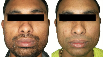 Venus Viva - Before and After 3 Treatments. &nbsp;Photos provided courtesy of Venus Concept, performed by Megha Joy Shah, MD.
