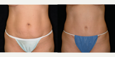 35-44 year old woman treated with Mini Tummy Tuck - mini TT, low incision, in office under sedation
