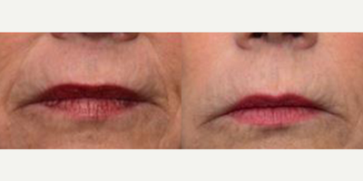 Woman treated with ThermiSmooth - ThermiSmooth