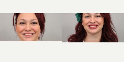 Filler Treatment - Meaningful Beauty +&nbsp;Filler Treatment to the lips
