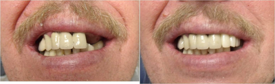 Mini Dental Implants replacing missing teeth  - Missing teeth were replaced by mini-implants. The before and after photos shown were taken on the same day of the procedure. Patient left the day of the procedure with a temporary bridge in place.