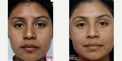 18-24 year old woman treated with Vi Peel - The peel will reduce hyperpigmentation, improve sun damage, diminish wrinkles, and eradicate acne scarring. The VI Peel is safe for all ages, skin types, and ethnicities.