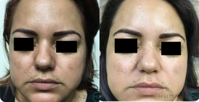 35-44 year old woman treated with Vampire Facial - 35-44 year old woman treated with Vampire Facial
