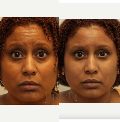 Under-eye filler and Dysport treatment - This woman wanted to improve the look of her under-eye bags and dark circles. Dr. Kotlus performed cannula tear trough filler along with Dysport to soften the forehead lines.