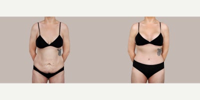 25-34 year old woman treated with Tummy Tuck, Breast Lift - 25-34 year old woman treated with Tummy Tuck, Breast Lift