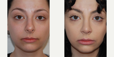 25-34 year old woman treated with Rhinoplasty, Silikon 1000, Lip Fillers - Our 28 year old beautiful patient is seen 1 year after functional and cosmetic rhinoplasty surgery. She was bothered by a distracting and over-projected nasal appearance. Additionally, she had a deviated nasal septum to the left and narrowing of her internal nasal valves on both sides. On profile, you can see a textbook 'tension lip deformity.' The functional portion of her surgery included septoplasty, turbinate reduction, and spreader grafts to enlarge her internal nasal valves. You can see a narrower and less distracting nasal appearance. She's also breathing much better. Additionally, we performed a single permanent lip augmentation treatment with microdroplet Silikon-1000. Can also see natural looking and permanent lip augmentation in her after photos.