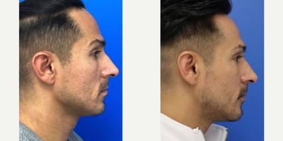 25-34 year old woman treated with Microneedling, Skin Rejuvenation - After 4 sessions of PRP with scar subcisions by PA Steve.