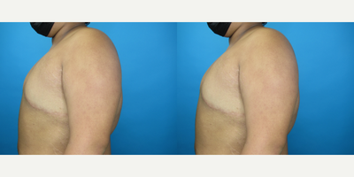 Woman treated with Mastectomy - Woman treated with Mastectomy