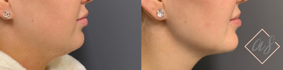 18-24 year old woman treated with Lipodissolve - 18-24 year old woman treated with Lipodissolve (one treatment)for excess submental fat using a cannula.Photos taken immediately before and 2 monthsafter treatment.