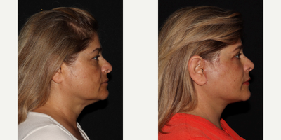 55-64 year old woman treated with Facelift, Eyelid Surgery, Laser Resurfacing, Facial Fat Transfer, Rhinoplasty - MD Restore, Deep-Plane (Additional Procedures: Eyelids, Laser Resurfacing, Fat Transfer, Rhinoplasty)