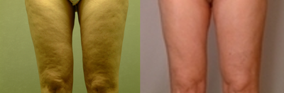 Smart Lipo-Liposuction - This female patient is 140lbs. 5'10 and had SmartLipo laser assisted liposuction with cellulite removal.