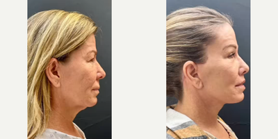 Woman treated with Neck Lift - Woman treated with Deep Plane Facelift, Neck Lift with reduction of glands and muscle, Lip Lift, Brow Lift, Eyelid Surgery, and Facial Fat Transfer.