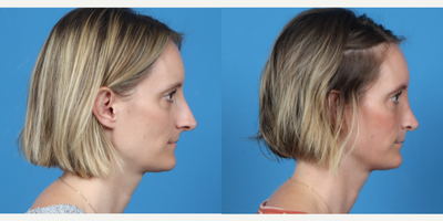 35-44 year old woman treated with Rhinoplasty - Rhinoplasty