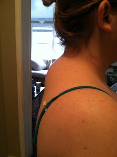 painful lipoma painful lipoma