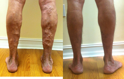 Expert varicose vein treatment - Treating bulging varicose veins requires an expert who understands how to diagnose the problem correctly and has a combination of tools to customize the solution. Dr. Malvehy performed a combination of laser EVLT, microphlebectomy, and foam sclerotherapy with Asclera in this patient during a single session. All treatments are performed in the office under local anesthesia, with no downtime. After picture taken about 1 year after. This patient recently had their 5 year follow up&nbsp;