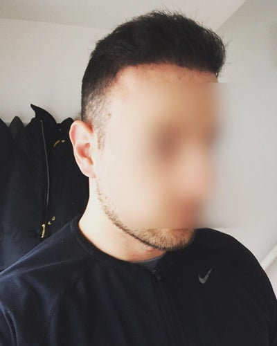 Hair Of Istanbul Hair Transplant On 16th April 2018 Review
