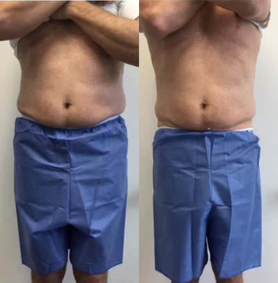 45-54 year old man treated with UltraShape Power - This is a 44 year old male treated with 3 UltraShape Power treatments spaced 2 weeks apart.