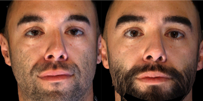 25-34 year old man treated with Contour Thread Lift - Thread Lift through Temples plus Volume with Sculptra