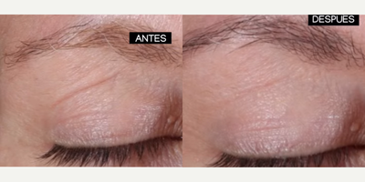 Woman treated with Skin Rejuvenation, Skin Tightening - A revolutionary skincare line: Alastin. Their products are designed to visibly improve the skin's appearance, promoting its regeneration and firmness. The synergy between Alastin products and specialized treatments maximizes cell renewal, offering a visible and lasting transformation that will allow you to show radiant, healthy skin.