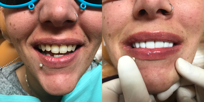 18-24 year old woman treated with Porcelain Veneers - This young lady received 18 porcelain veneers (10 top and 8 bottom) that were done by Dr. Sarah Thompson. Took only two appointments (2 weeks apart).&nbsp;
