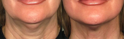 Woman treated with Nonsurgical Facelift - Woman treated with Nonsurgical Facelift