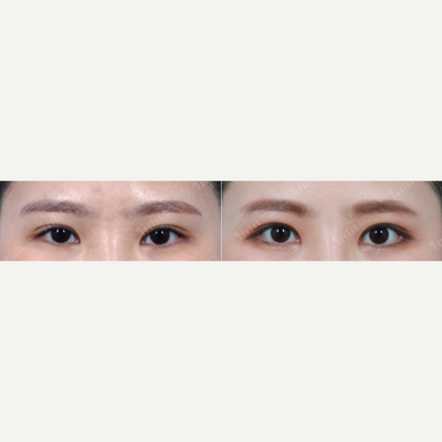 Dual Canthoplasty (Lateral Canthoplasty with Lateral Hotz) - 3 months post-opDual canthoplasty. Lateral canthoplasty with lateral hotz (lowering the outer corner)