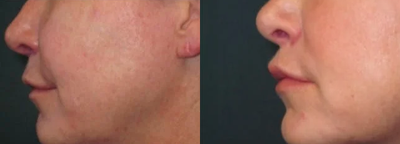 45-54 year old woman treated with Lip Lift - Lip lift