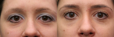Pelleve - 32 year old young lady who had a series 6 Pelleve treatments one month apart. After picture is 8 months after the first treatment. Pelleve is a painless, non-invasive treatment with no downtime.