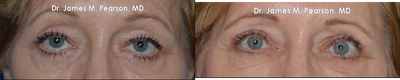 Upper Eyelid Lift / Blepharoplasty - 
	Upper Eyelid Lift / Blepharoplasty
