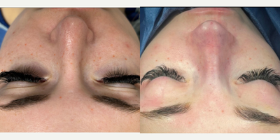 Revision Rhinoplasty Finesse - This patient came to me after having an unsuccessful rhinoplasty in town. She was left with a pollybeak deformity (excess supratip tissue), alar retraction, twisted tip and excess columellar show. She had no cartilage remaining in her septum, so I performed rib harvest to obtain the cartilage needed for structural support. Here she is on the table, with much more definition, narrowed and straightened nasal bones, and elimination of alar retraction.
