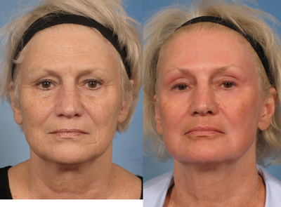 64 year old female treated with a Croton Oil Phenol Peel for Facial Wrinkles - 64 year old female treated with a Croton Oil Phenol Peel for Facial Wrinkles