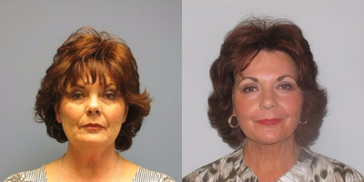 Woman treated with Quick Lift - 3 mo post Quick Lift