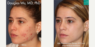 18-24 year old woman treated with Photodynamic Therapy - Photodynamic therapy with Clear+Brilliant laser to treat active acne on a female patient by Dr. Wu.