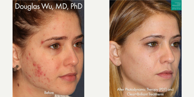 25-34 year old woman treated with Photodynamic Therapy - Photodynamic therapy with Clear+Brilliant laser to treat active acne on a female patient by Dr. Wu.
