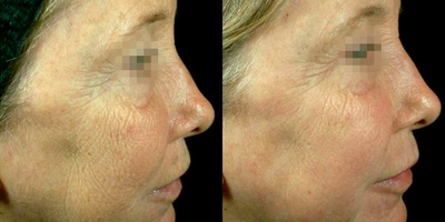 Woman treated with Pearl Laser - Pearl Laser