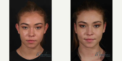 18-24 year old woman treated with Otoplasty with Earfold - This pretty girl had a mild form of prominent ears, and we used Earfold to improve the harmony. She went back to high school the following day without a headband.