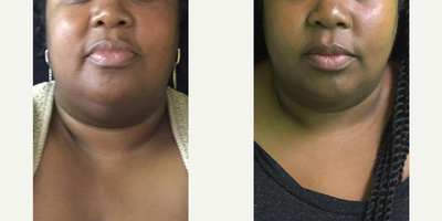 35-44 year old woman treated with CoolMini - 1 treatment