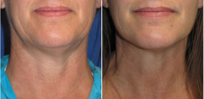35-44 year old woman treated with Velashape - This patient is 42 year old female who had three Velashape treatments, 2 weeks apart.