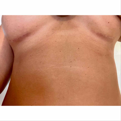 Portica Body & Face - Before & After scarless breast reduction for this  lovely 62 year old woman who despite her petite size (110 lbs) developed a  very large chest (32DD) in