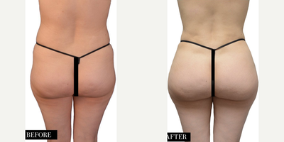 Woman treated with Brazilian Butt Lift - Woman treated with Brazilian Butt Lift
