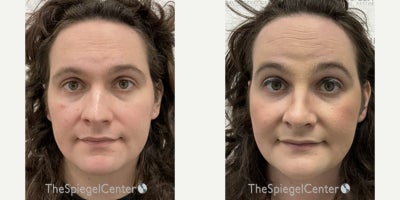 25-34 year old woman treated with Facial Feminization Surgery - 25-34 year old woman treated with Facial Feminization Surgery