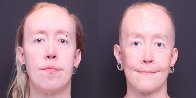 35-44 year old transgender woman treated with Facial Feminization Surgery - Facelift, cheek augmentation with implants (BSM-XL), maxillary augmentation (BPI-L), mandible/chin contouring, sliding genioplasty, submental liposuction, HALO-full face