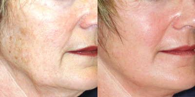 45-54 year old woman treated with Chemical Peel - 35%TCA for fine lines and hyperpigmentation combined with minilift