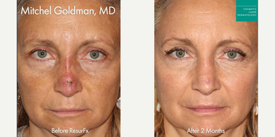 Woman treated with ResurFX - Woman treated with ResurFX