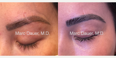 Woman treated with Eyebrow Transplant - Woman treated with Eyebrow Transplant