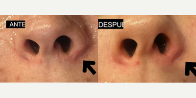Patient treated with Stellar M22, YAG Laser - Say goodbye to those pesky red veins! With our Stellar M22 platform and its ND YAG laser technology, we can definitively treat those vascular injuries, red moons, spider webs, or telangiectasis with minimal pain and without disability