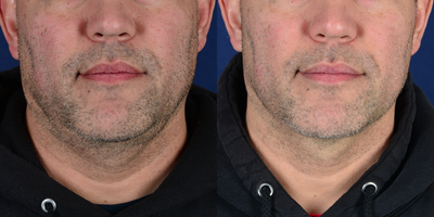 55-64 year old man treated with CoolMini - Patient desired treatment for fat of the submentum (double chin). He was treated with Coolmini (fat reduction).